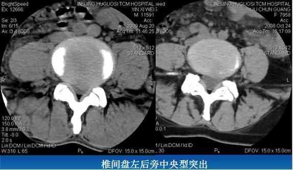 腰椎管狭窄的磁共振诊断标准,腰椎轻度退行性变化椎间盘膨出
