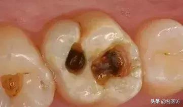 如果蛀牙已经烂了怎么办,如果蛀牙只剩一点牙根了咋办