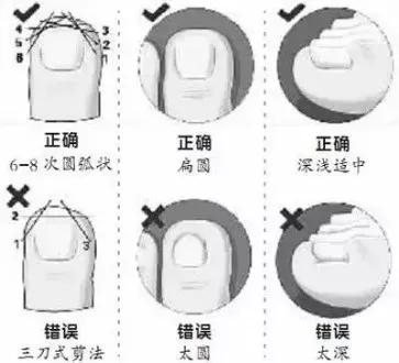 跑步跑出黑指甲怎么处理,跑步脚上出现黑趾甲该怎么处理