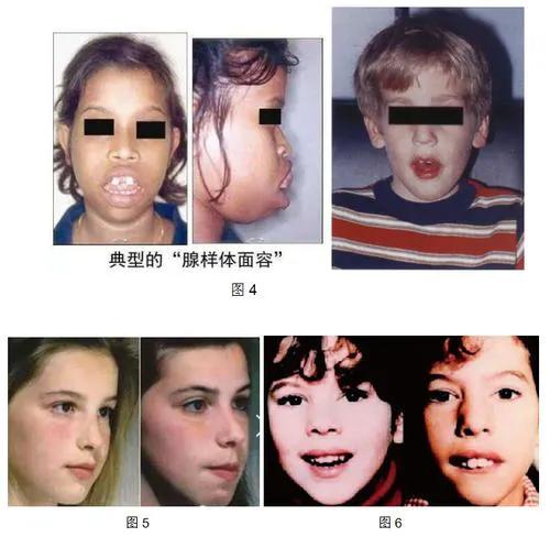 5岁男孩睡觉打呼噜的原因,儿童睡觉打呼噜的常见原因