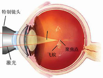 飞蚊症眼前有黑影原因,眼睛看到飞蚊症是怎么回事