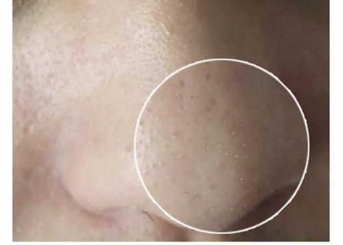 脸上黑头粉刺怎么去除最有效,脸上粉刺黑头怎么去除最有效