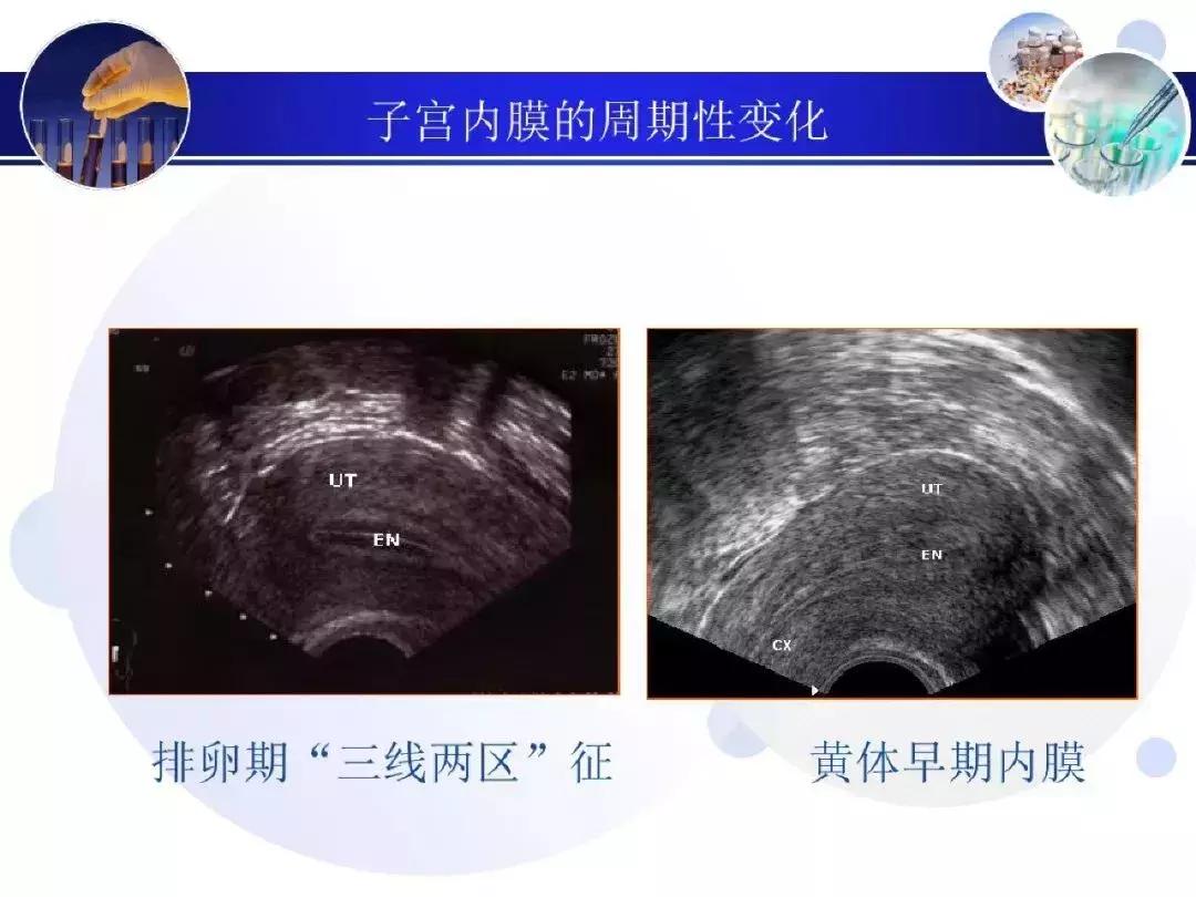 纯干货！子宫及附件解剖和超声诊断