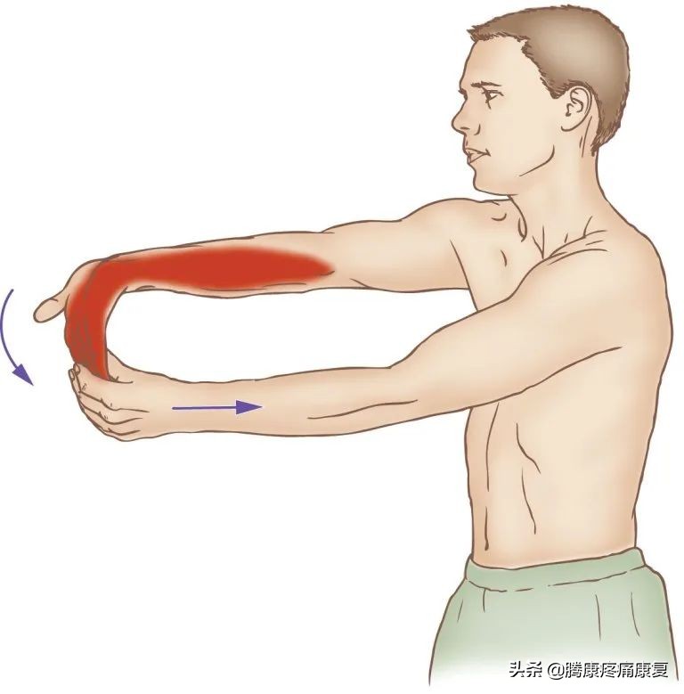 腕和手的多处屈肌和肌腱损伤,前臂神经卡压原因
