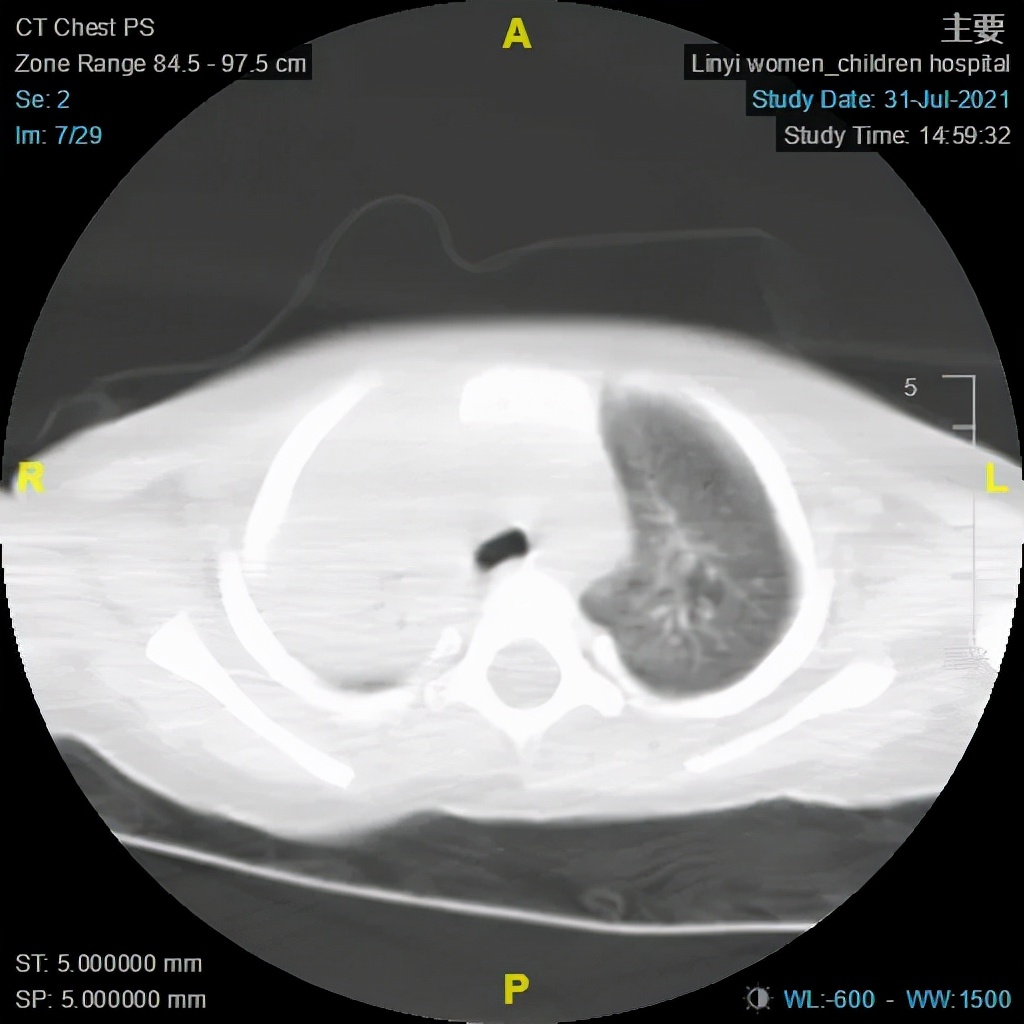 小孩肺炎支气管镜洗肺过程,肺炎总是不好怎么办
