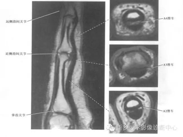 单只手指磁共振,手指用磁共振能做出来结果吗
