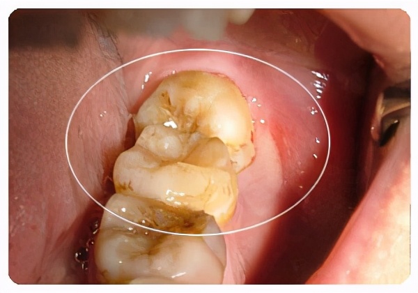 智齿拔牙后一般要痛多久,智齿拔牙不拔牙根会怎样