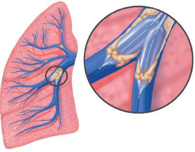 血栓高血压的症状和治疗,慢性肺血栓栓塞性肺动脉高压预后