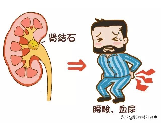 尿结石的自白书：想赶我走？让我来给你指条明路