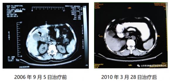 于保法看癌症的真实经历,肿瘤治疗专家于保法