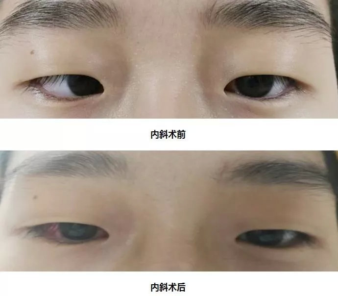 关于儿童斜视,斜视家长关心的100个问题