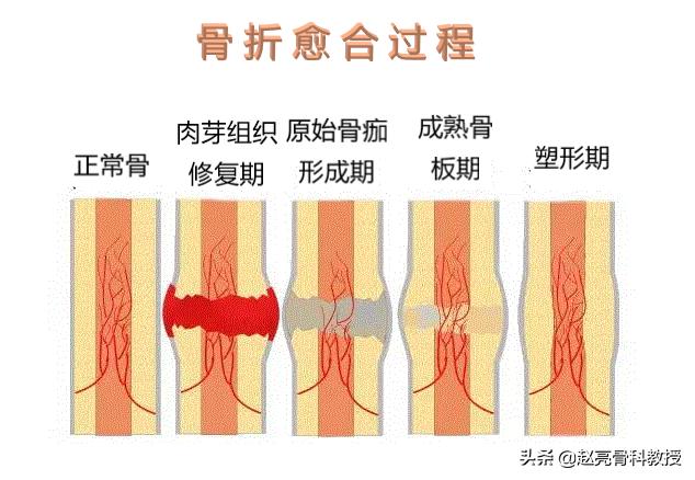 骨科医生告诉你:骨折后，吃什么有助康复愈合。