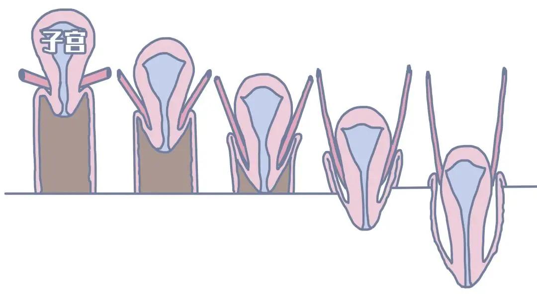 23岁子宫早衰,23岁子宫下垂怎么办