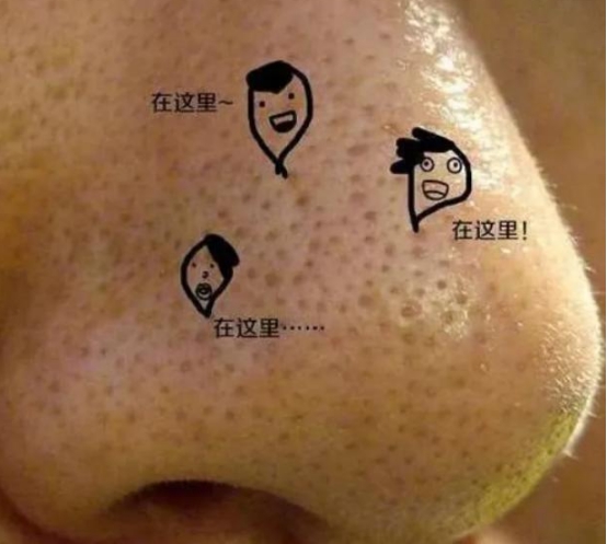 婴儿黑头怎么处理脸颊,如何去黑头5个诀窍告别草莓鼻