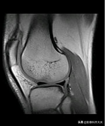 膝关节半月板损伤的磁共振,膝关节半月板病变的mri诊断与鉴别
