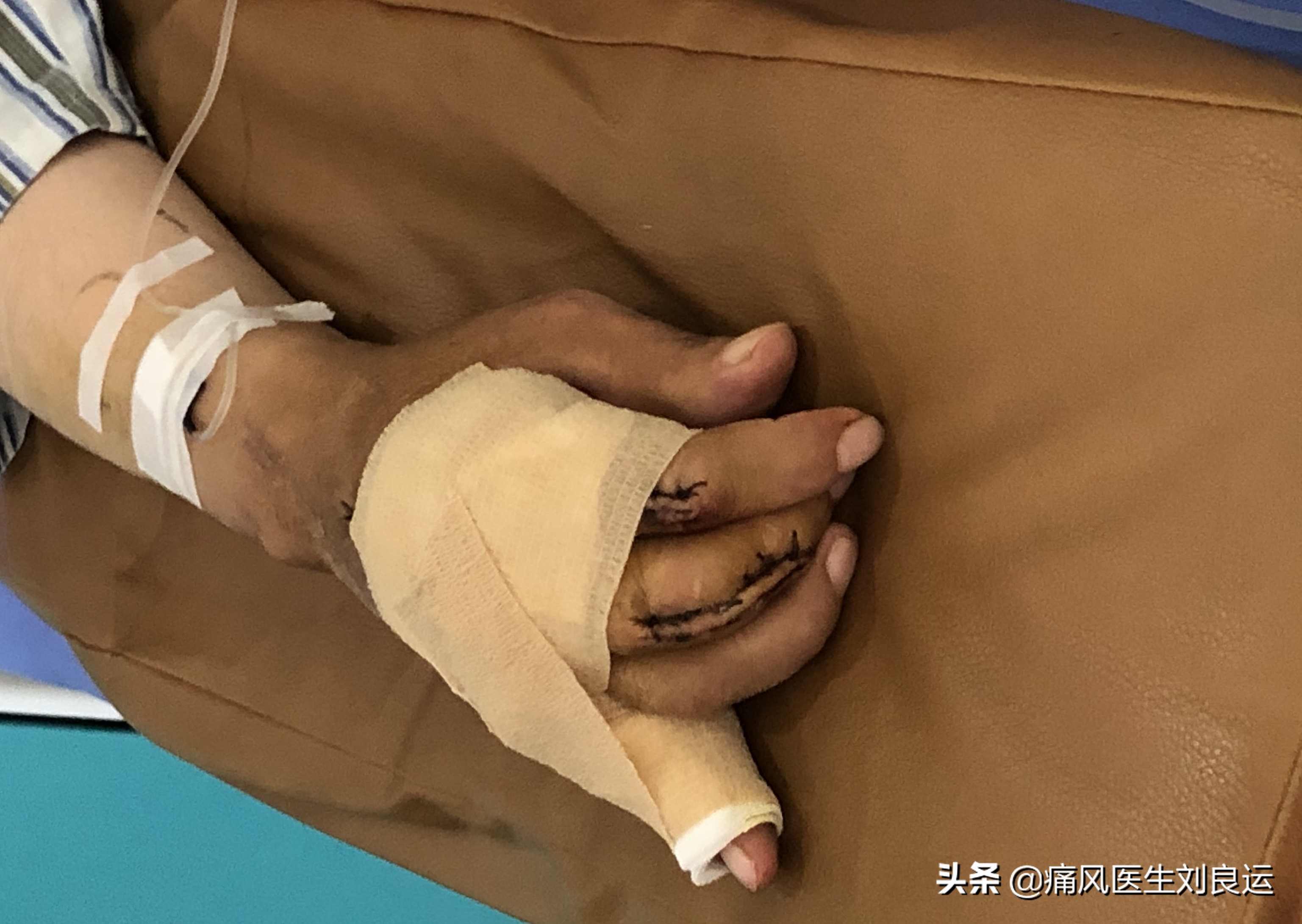 我和我20多年的婚姻，因为痛风20年的丈夫长出痛风石遭遇考验