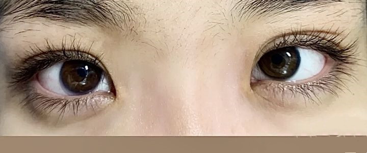 看完再决定要不要入坑,怎样判断需不需要开外眼角