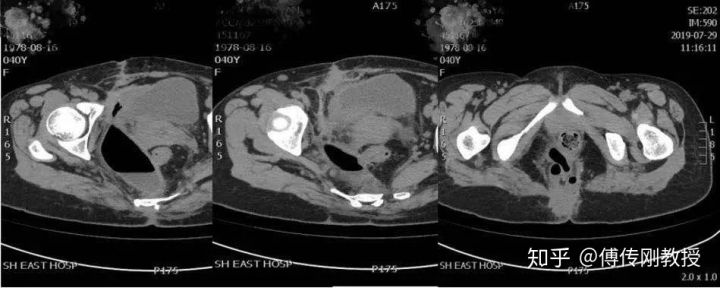 经历各种手术才活下来,经历了很多次手术