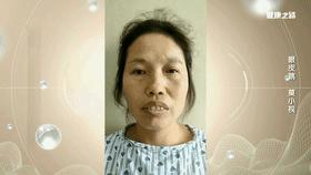 眼皮持续跳警惕面肌痉挛青光眼,眼皮跳可能是面肌痉挛惹的祸