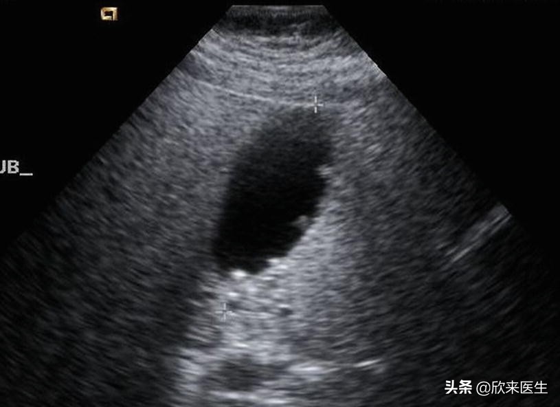 公务员入职体检胆囊息肉有影响吗,胆囊息肉要紧吗影响公务员体检吗