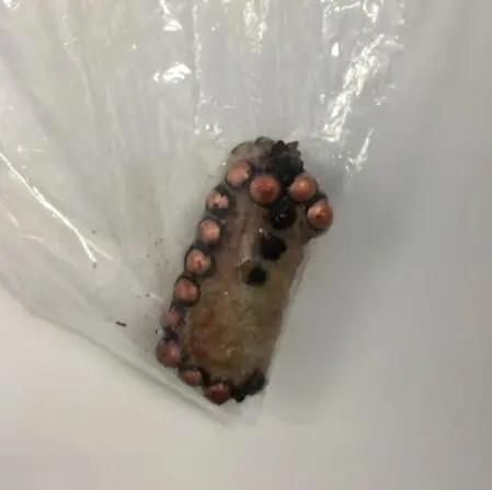 四岁孩子耳朵里塞进钢珠,小男孩往泥巴里塞6个钢珠