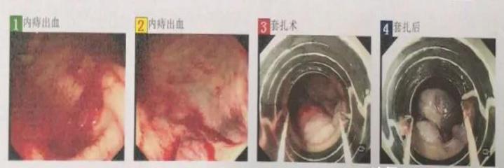 做肠镜喝泻药痔疮出来了怎么办,肠镜检查发现有痔疮可以切掉吗