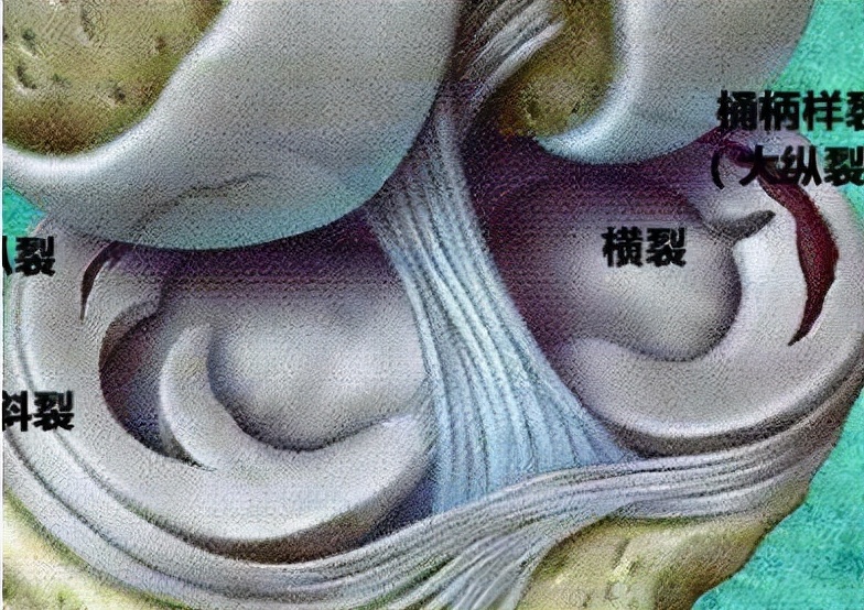 微创手术能治好骨性关节炎吗,膝盖关节镜微创手术要脱衣服吗