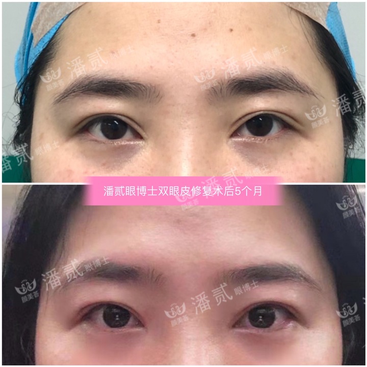 割双眼皮眼皮压下来会恢复吗,割双眼皮以后会松弛更快吗