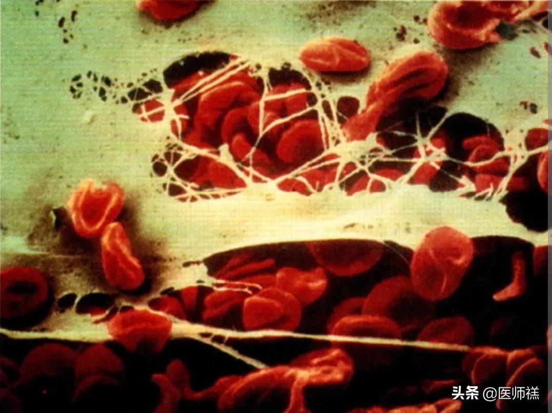 阿司匹林预防心血管,阿司匹林预防心脏的副作用与危害