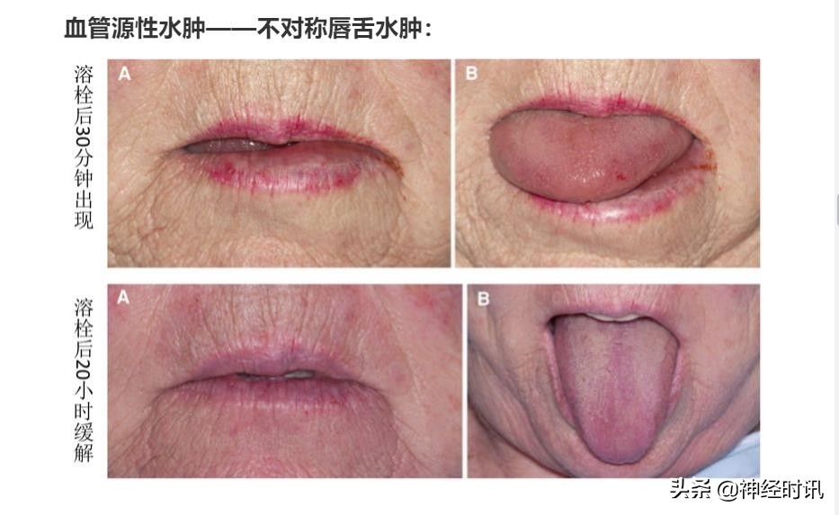 急性脑梗死取栓术的护理,脑梗死溶栓取栓围手术期护理常规