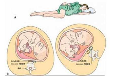 脐带绕颈二圈怎么纠正,脐带绕颈是什么造成的