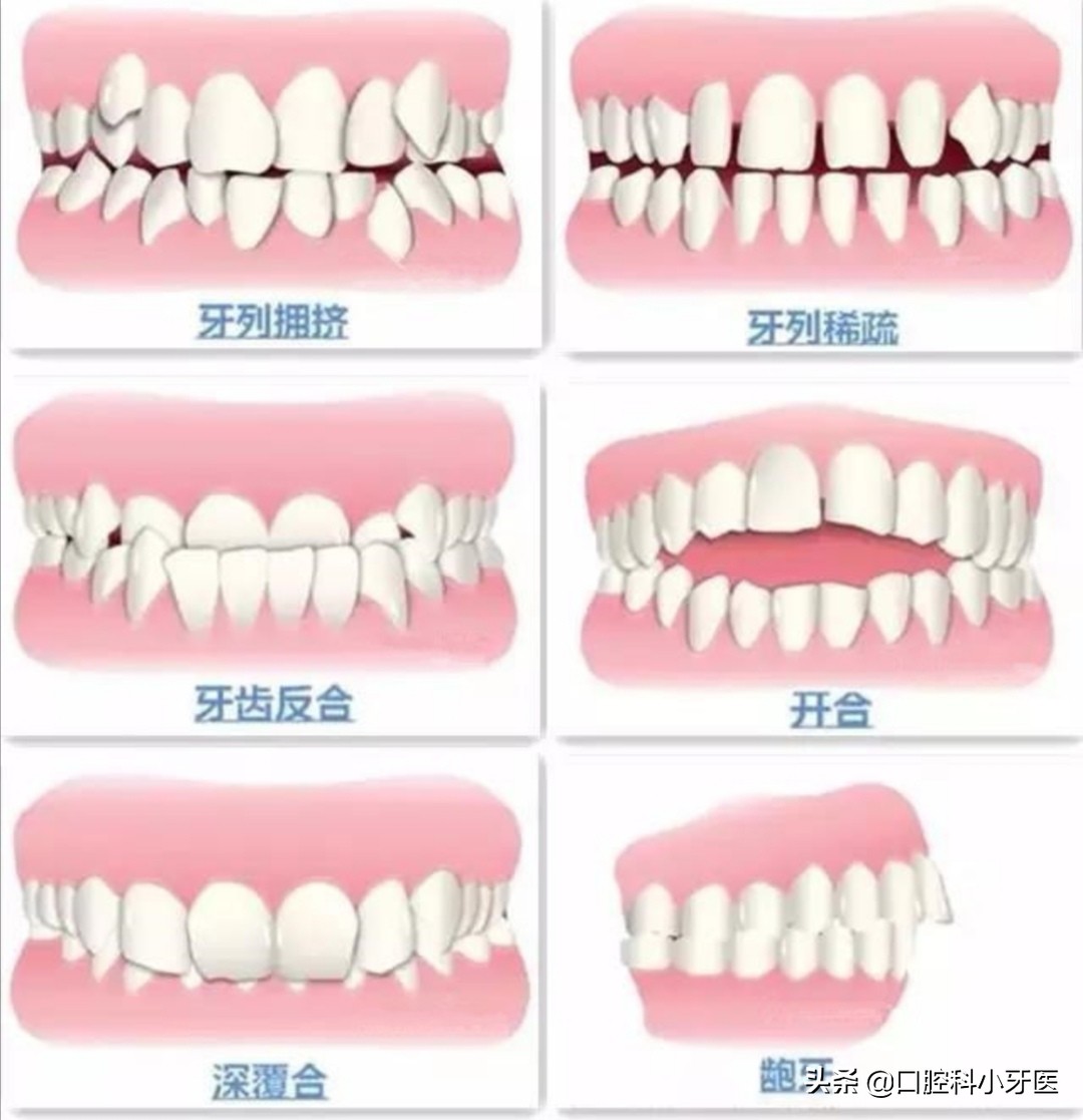 牙医的良心忠告牙齿矫正,别急着牙齿矫正先弄懂这10件事