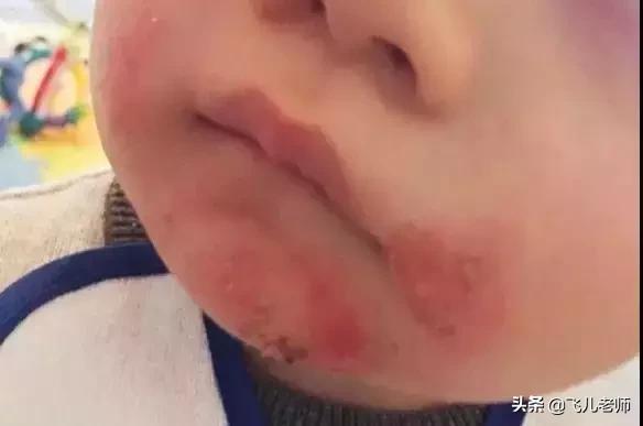 捏宝宝的脸蛋口水会变多吗,宝宝口水疹快速消除小妙招