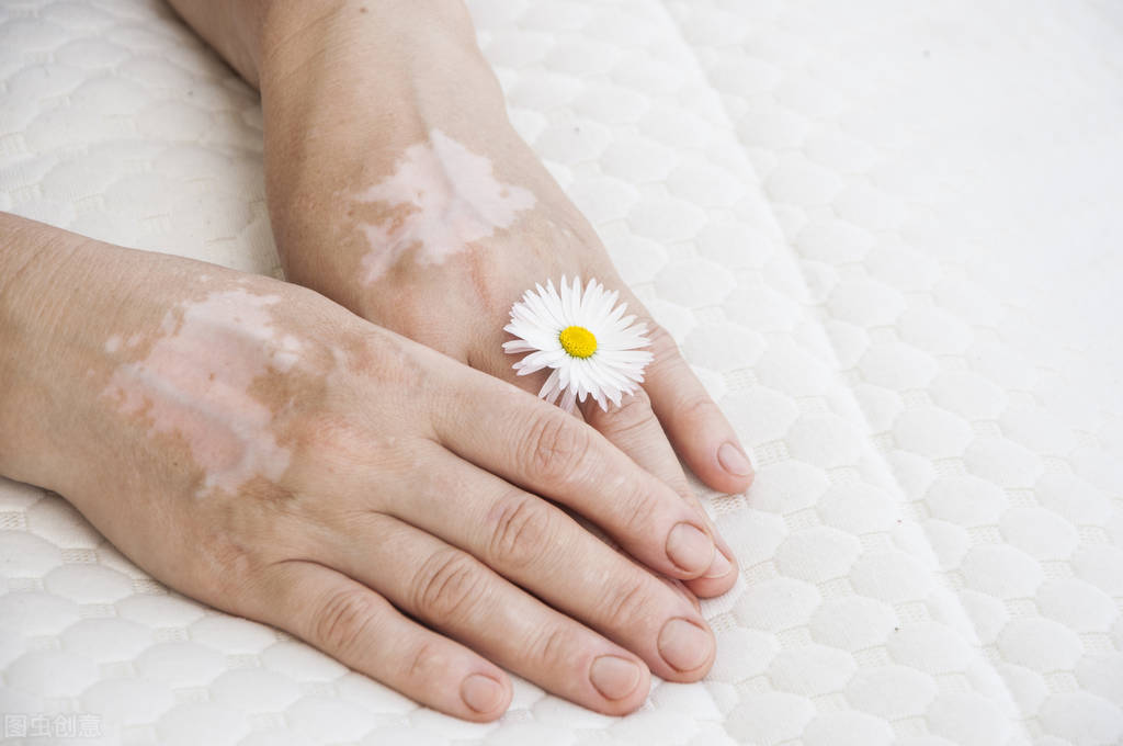 年轻人特发性白斑怎么治疗,成年人白斑消除最好的方法