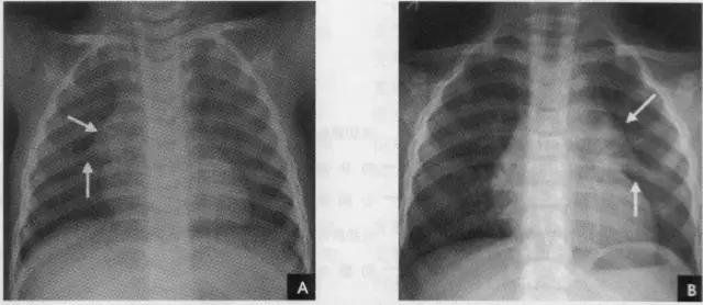 详细的胸部X线解剖，最基础最实用！