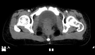 直肠癌放化疗后两年未复发,直肠癌术后放化疗有复发的吗