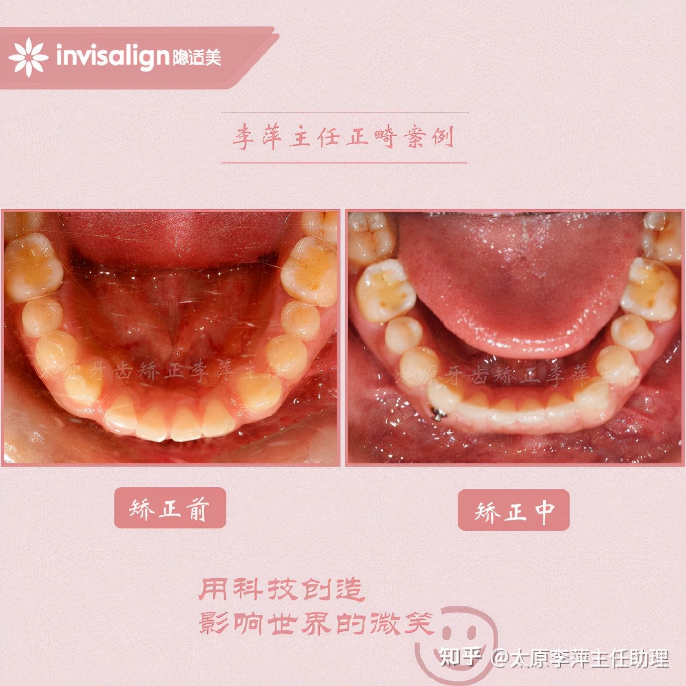 重度拥挤矫正牙齿适合隐形牙套吗,广州成人牙齿矫正推荐隐形牙套