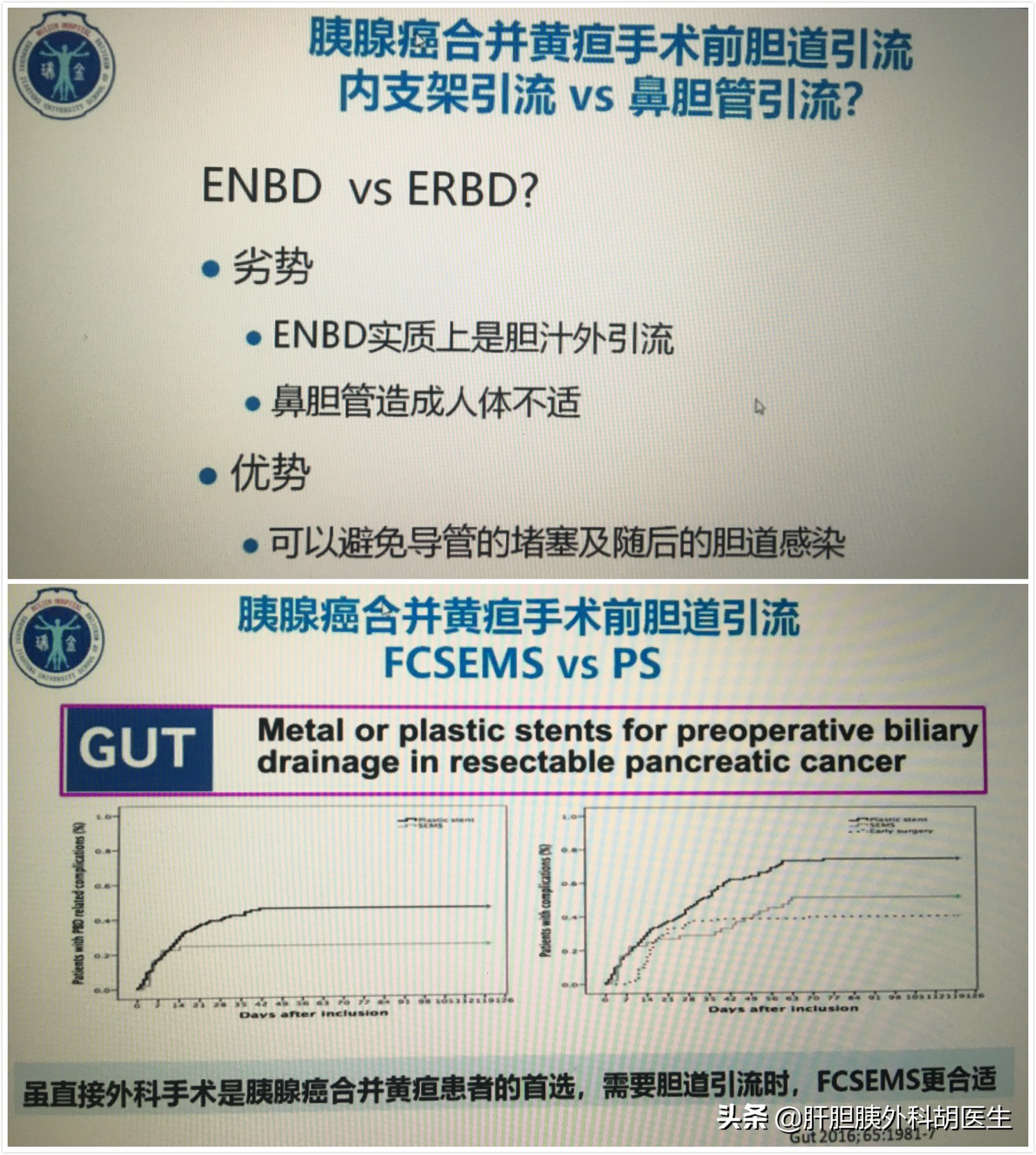 胰腺癌手术后肝转移出现黄疸,胰腺癌出现黄疸是早期还是晚期
