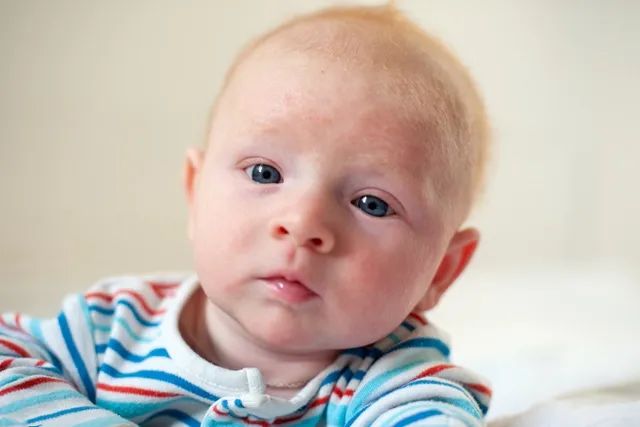 新生儿脱皮很严重是什么原因,新生儿有点脱皮什么原因