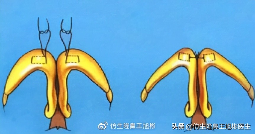 大鼻头缩小的改善原理,鼻头毛孔粗大如何改善缩小毛孔