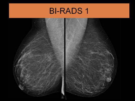 乳腺结节bi-rads分级依据,国内乳腺结节bi-rads分级标准