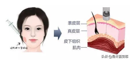 瘦脸针其实副作用挺大的吧,关于瘦脸的知识