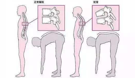 绝经妇女骨质疏松症辨证分型,更年期女性如何判断骨质疏松