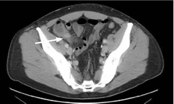 这种教科书中才有的阑尾炎并发症，击倒了强壮的健身教练