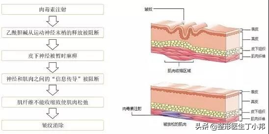 关于肉毒毒素注射,注射肉毒素注意什么