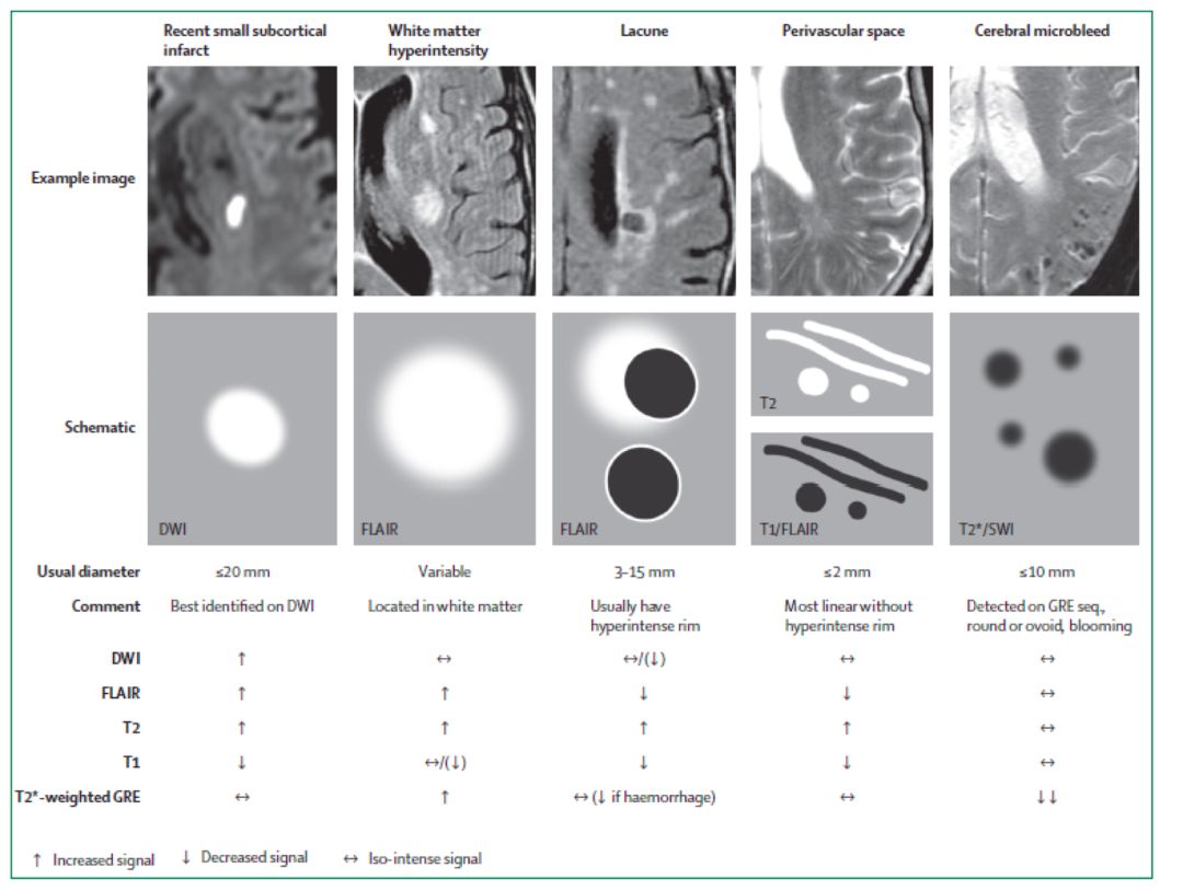 脑梗溶栓后脑出血脑疝晚期,阿替普酶溶栓后脑出血处理