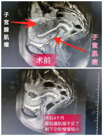 消除子宫肌瘤的特效药,消除子宫肌瘤最好中药