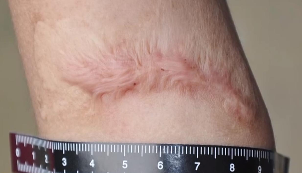 针扎、开水烫……她把9岁女儿打到全身骨折被捕后说“我觉得打她是对的”