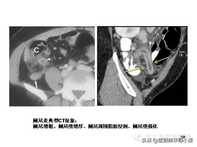 阑尾炎课件,阑尾炎的超声课件
