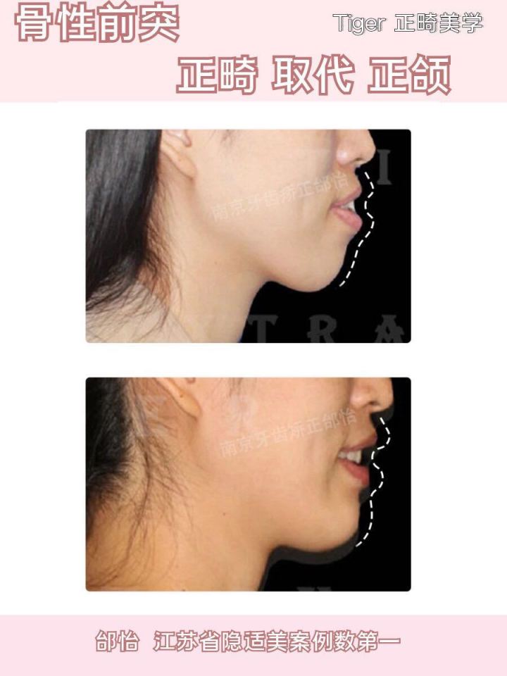 隐适美矫正危害,隐适美矫正真实案例